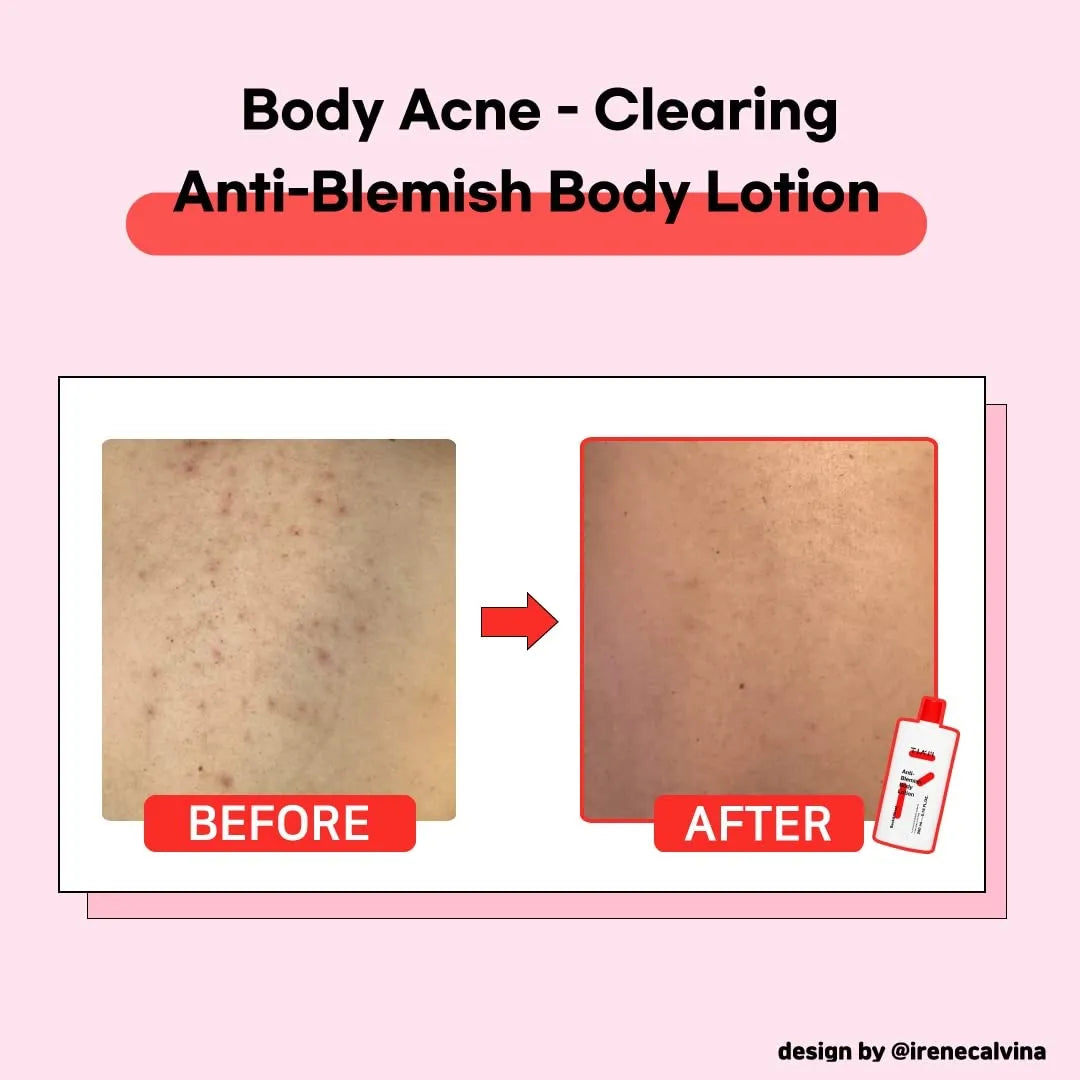 TIA'M Anti-Blemish Body Lotion, Body Acne Treatment